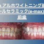 ホワイトニング後に前歯3本にオールセラミック（e-max）を入れた症例