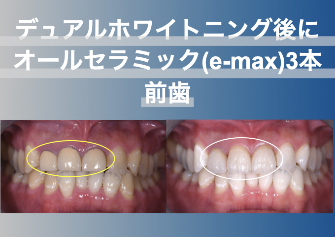 ホワイトニング後に前歯3本にオールセラミック（e-max）を入れた症例