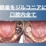 口腔内全ての銀歯をジルコニア（自費補綴）に作り替えた症例
