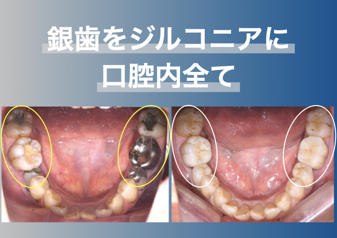 口腔内全ての銀歯をジルコニア（自費補綴）に作り替えた症例