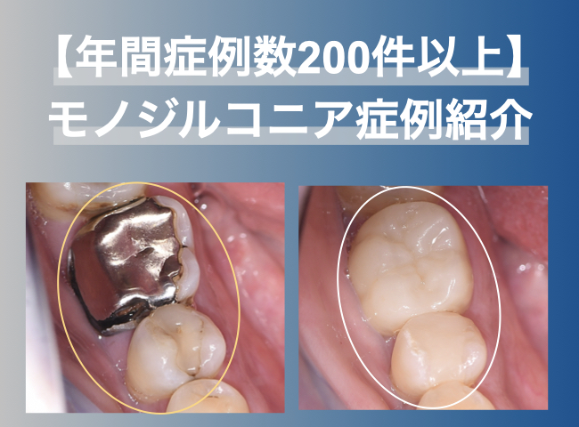 【年間症例数200件以上】モノジルコニア（自費補綴）症例紹介