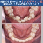 【症例紹介】約9ヶ月のインビザライン矯正で、歯のがたつきが改善されました！