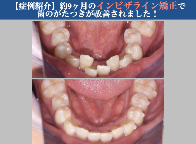 【症例紹介】約9ヶ月のインビザライン矯正で、歯のがたつきが改善されました！