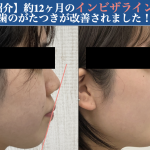 【症例紹介】約10ヶ月のインビザライン矯正で、口ゴボが改善されました！