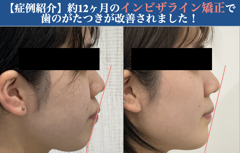 【症例紹介】約10ヶ月のインビザライン矯正で、口ゴボが改善されました！