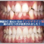 【症例紹介】約12ヶ月のインビザライン矯正で、歯のがたつきが改善されました！