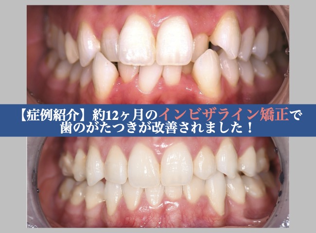 【症例紹介】約12ヶ月のインビザライン矯正で、歯のがたつきが改善されました！