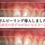 ガムピーリング導入しました！【歯茎の黒ずみが気になる方へ】