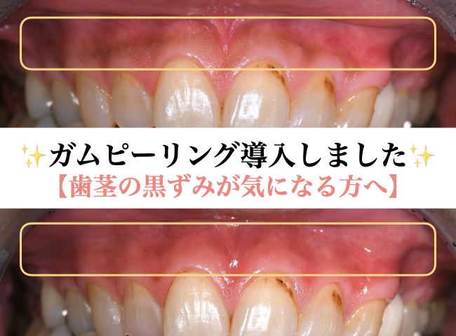 ガムピーリング導入しました！【歯茎の黒ずみが気になる方へ】