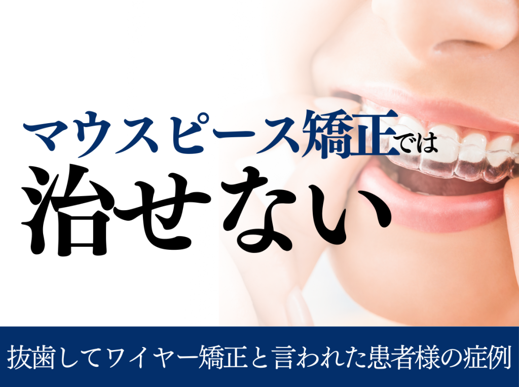 【症例紹介】他院で抜歯してワイヤー矯正でしか治らないと診断された患者様のお話