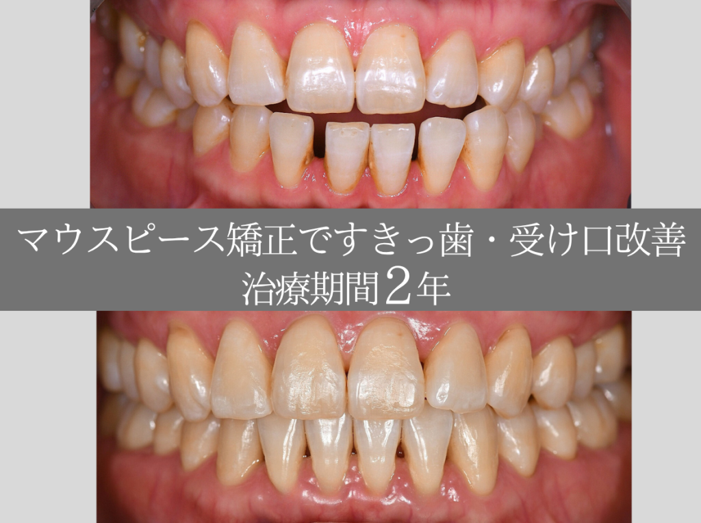 【症例紹介】約2年のマウスピース矯正で、すきっ歯と受け口が改善されました!