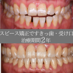 【症例紹介】約2年のマウスピース矯正で、すきっ歯と受け口が改善されました！