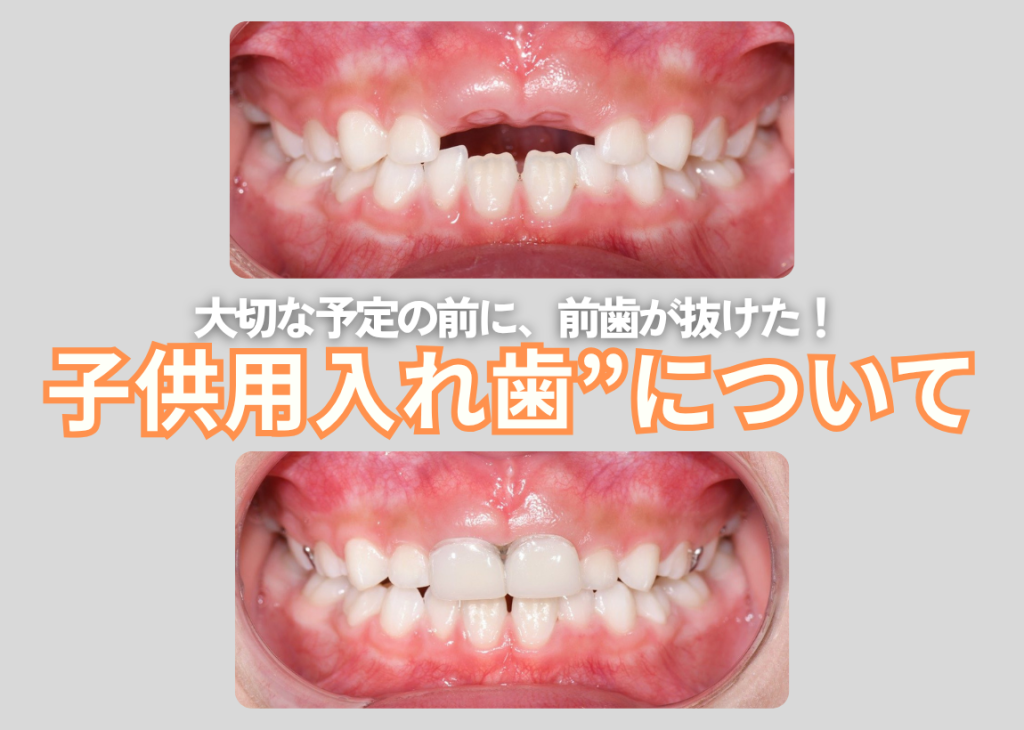 大切な日に子どもの前歯が抜けた！”子供用入れ歯”について