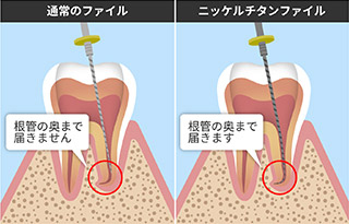 ニッケルチタンファイルの使用