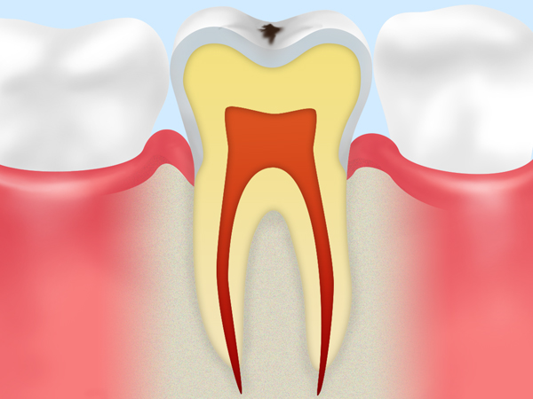 1. 歯の表面に白斑が生じる