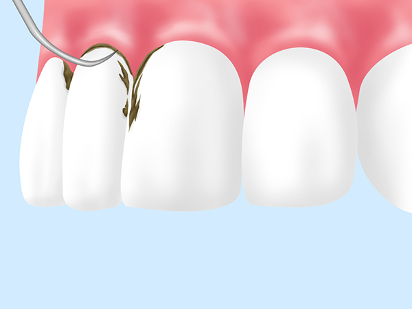 歯周基本治療