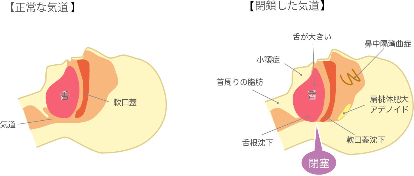 歯科用CTを活用した安全な抜歯処置