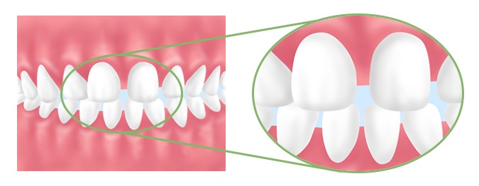 すきっ歯の原因と治療