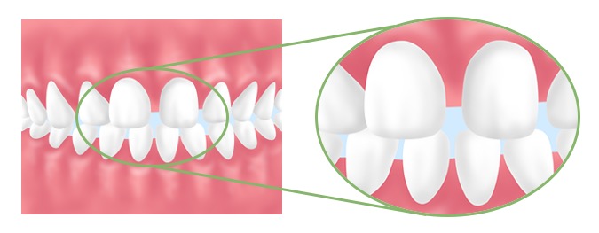 代表的なお悩み「すきっ歯」について